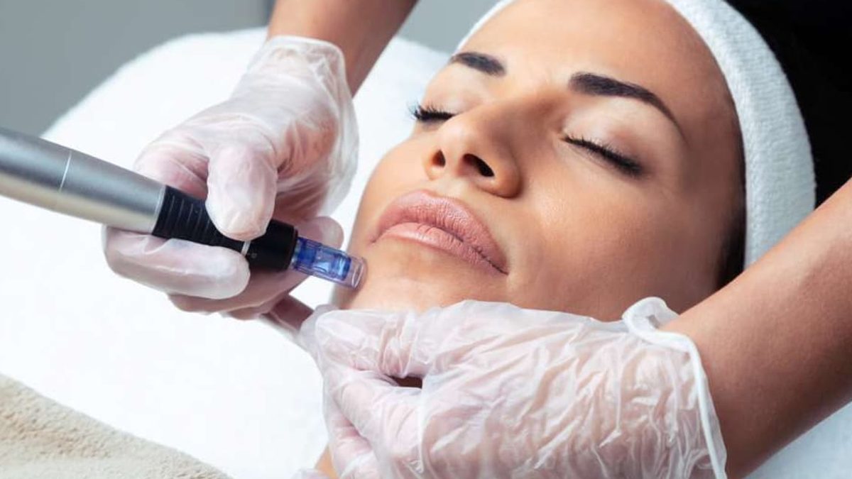 Is Microneedling Worth It? An Honest Assessment