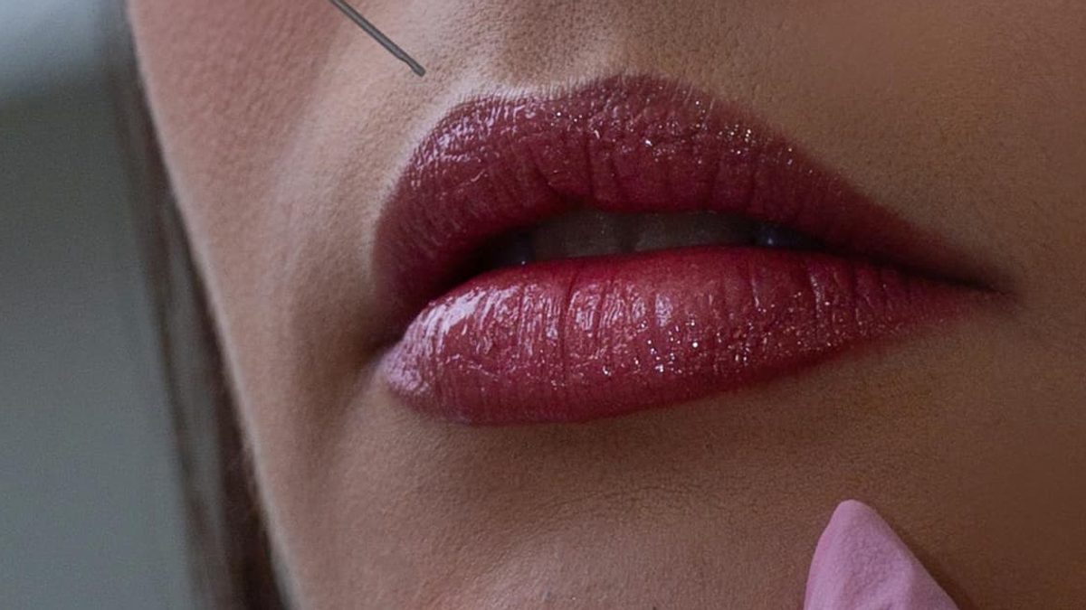 Lip Filler Migration: Why It Happens and How to Avoid It
