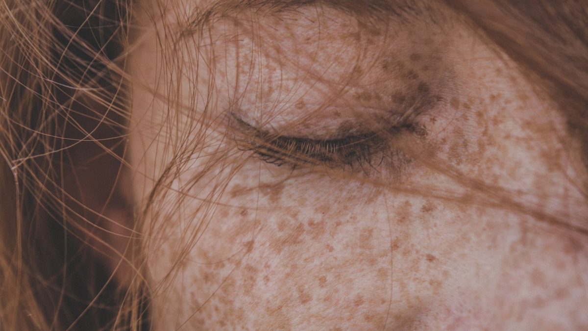 Melasma: Why It's So Hard to Treat (and What Works)