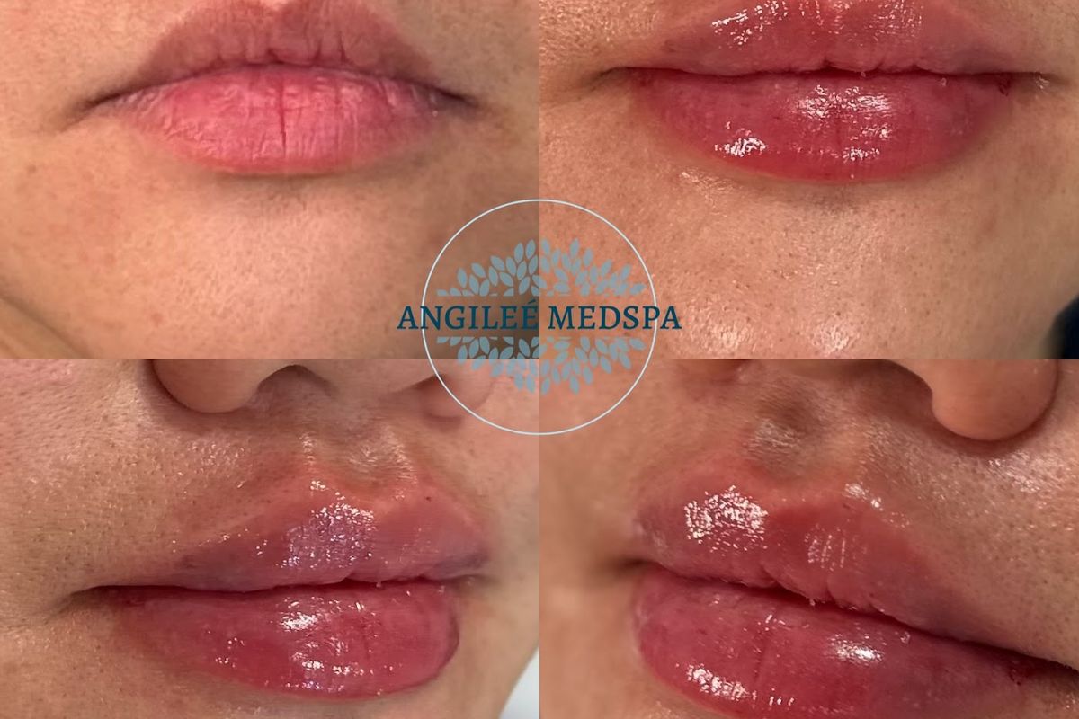Angileé Med Spa — Long Beach