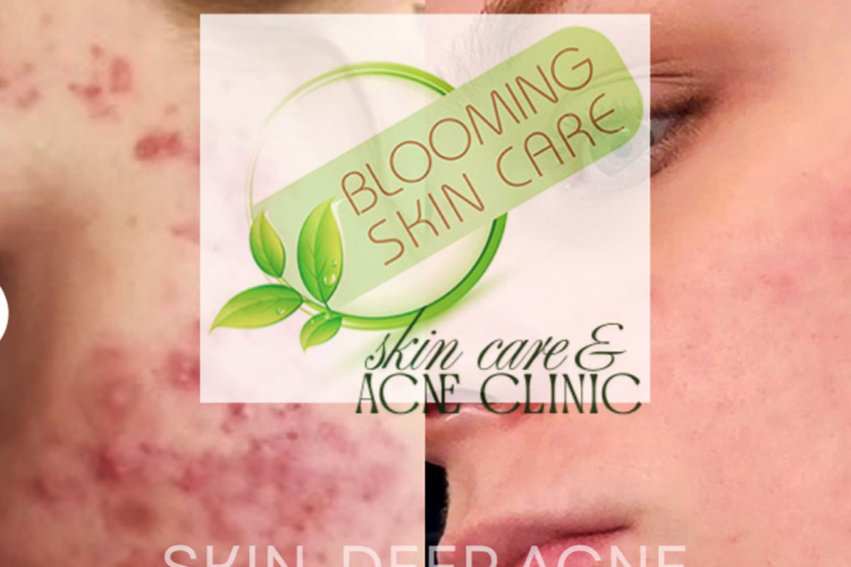 Blooming Skin Care & Acne Clinic, med spa and aesthetic clinic in Bloomington
