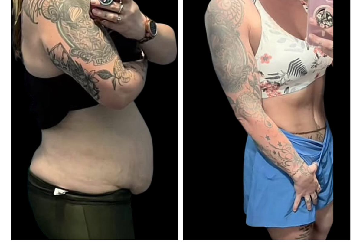 Buffalo Plastic Surgery — Buffalo