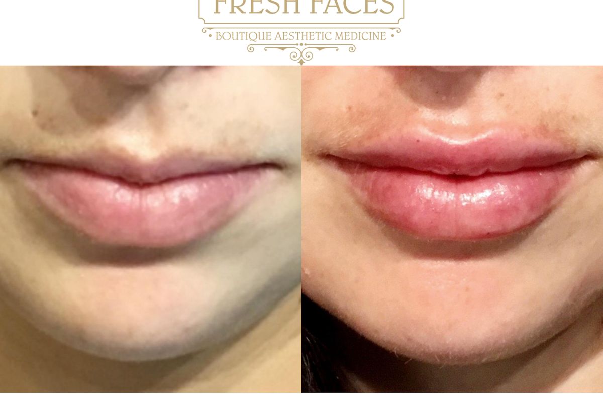 Fresh Faces RX | Advanced Aesthetics in Portland | Dr Jodee M Anderson MD, med spa and aesthetic clinic in Portland