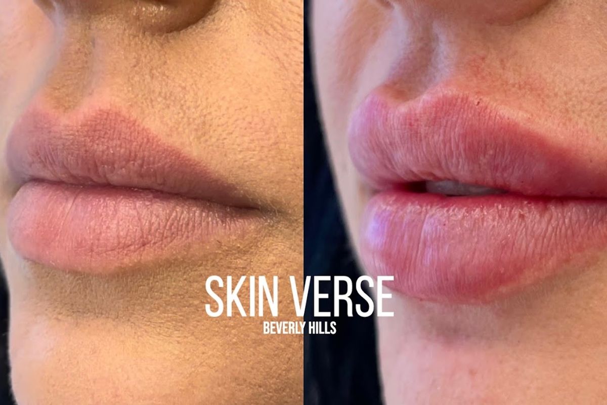 Skin Verse — Beverly Hills