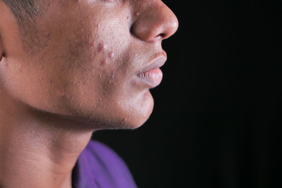 Active Acne / Breakouts