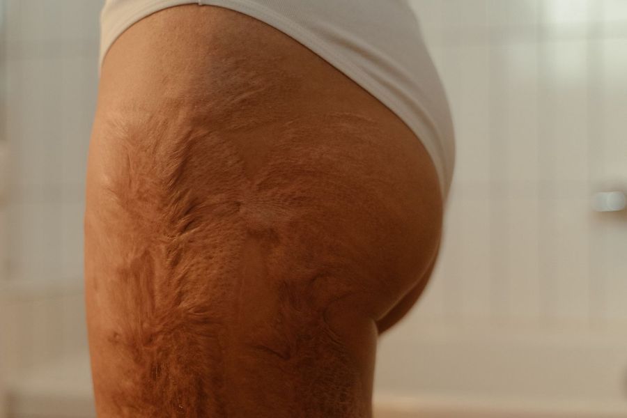 Cellulite