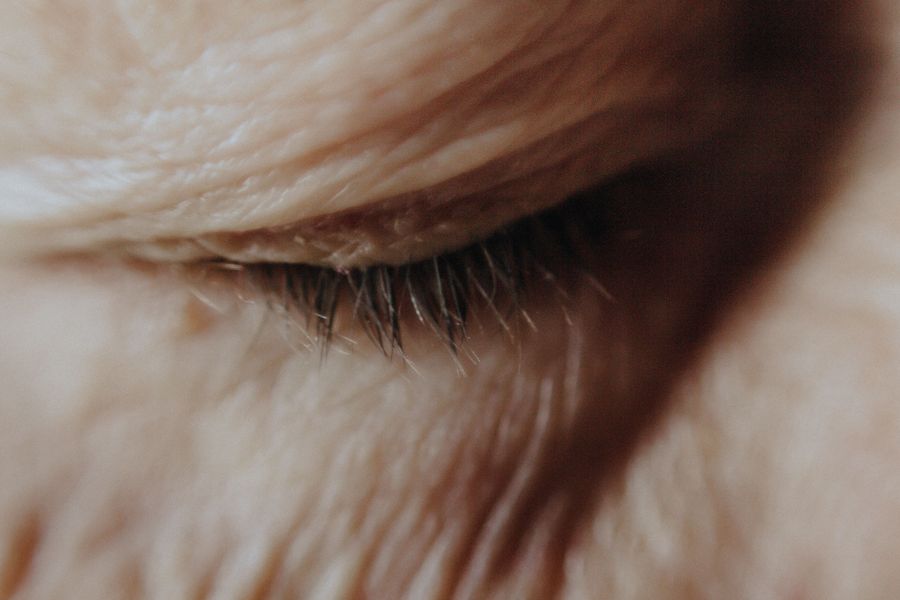 Crow's Feet: treatment options