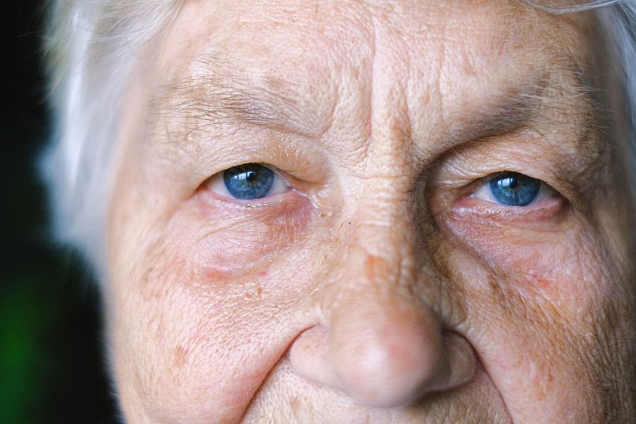 Heavy Eyelids: treatment options