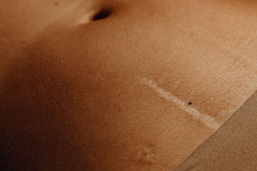 Keloids: treatment options