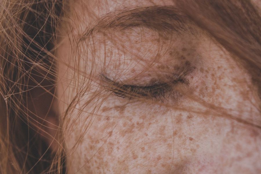 Melasma