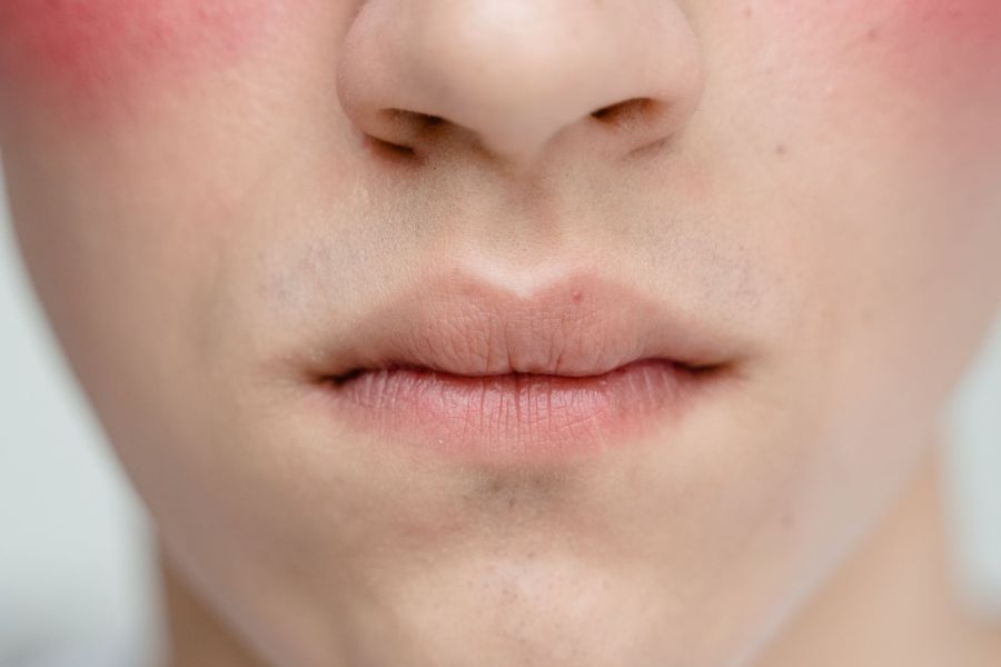 Facial Redness / Rosacea