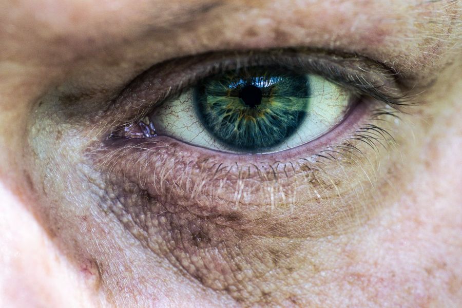 Under-Eye Bags & Dark Circles