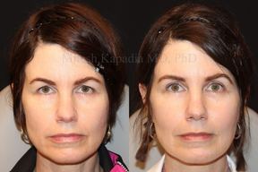 Boston Eyelid Surgery in Boston