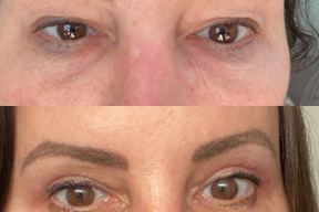 Dr. Mitesh Kapadia - Eyelid Surgery, Botox & Restylane in Newton