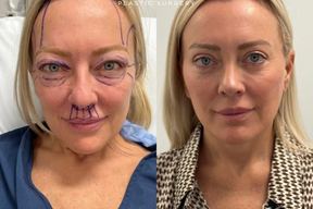 Kassir Plastic Surgery in New York
