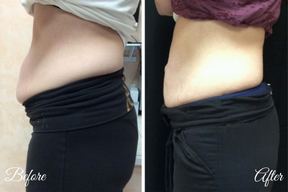 Metropolitan Dermatology - CoolSculpting Staten Island in Staten Island