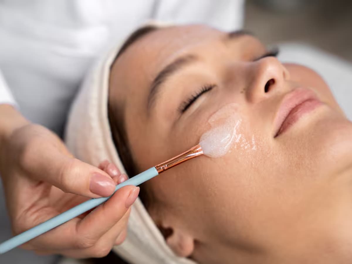 Chemical Peel