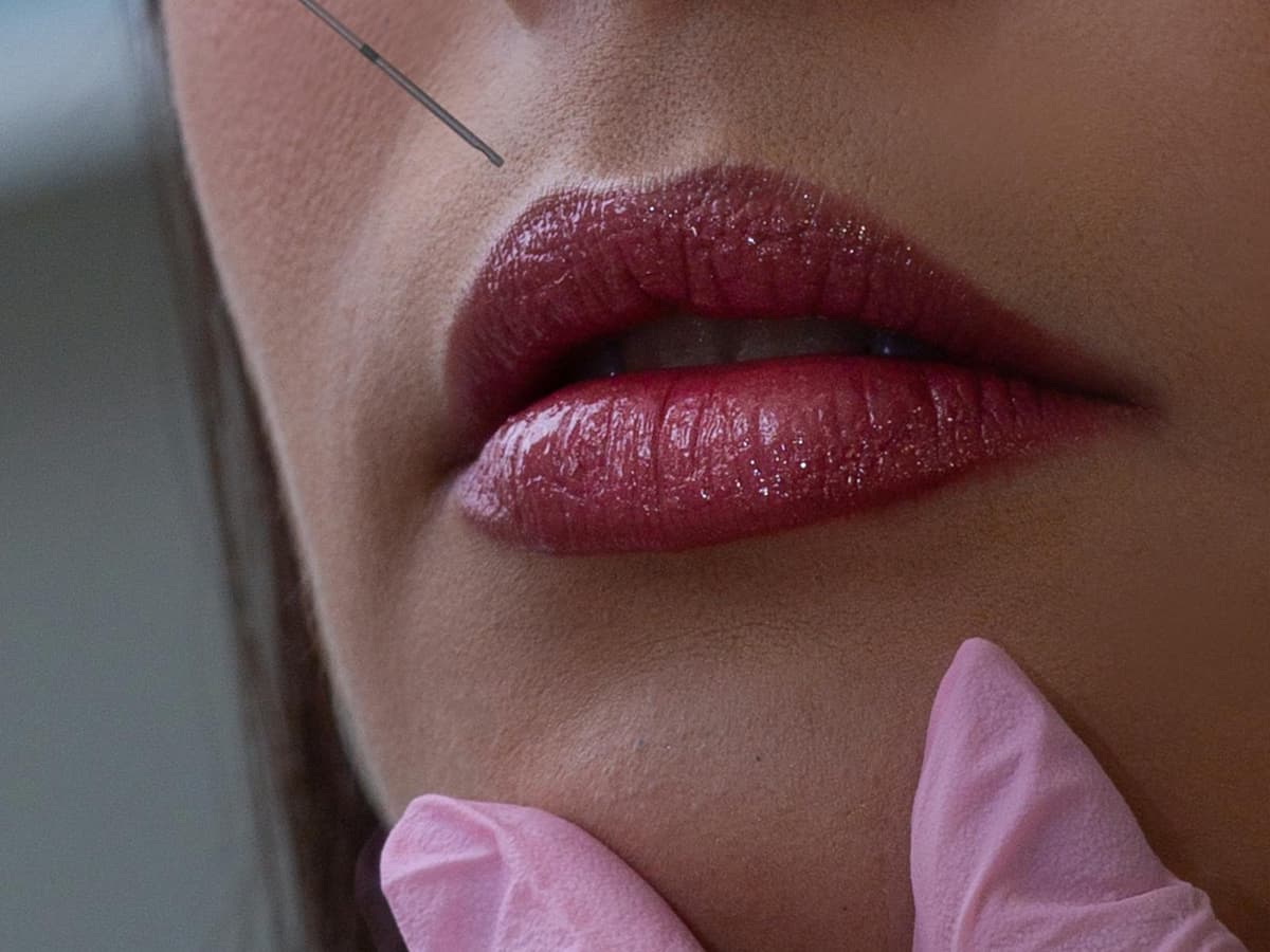 Lip Filler