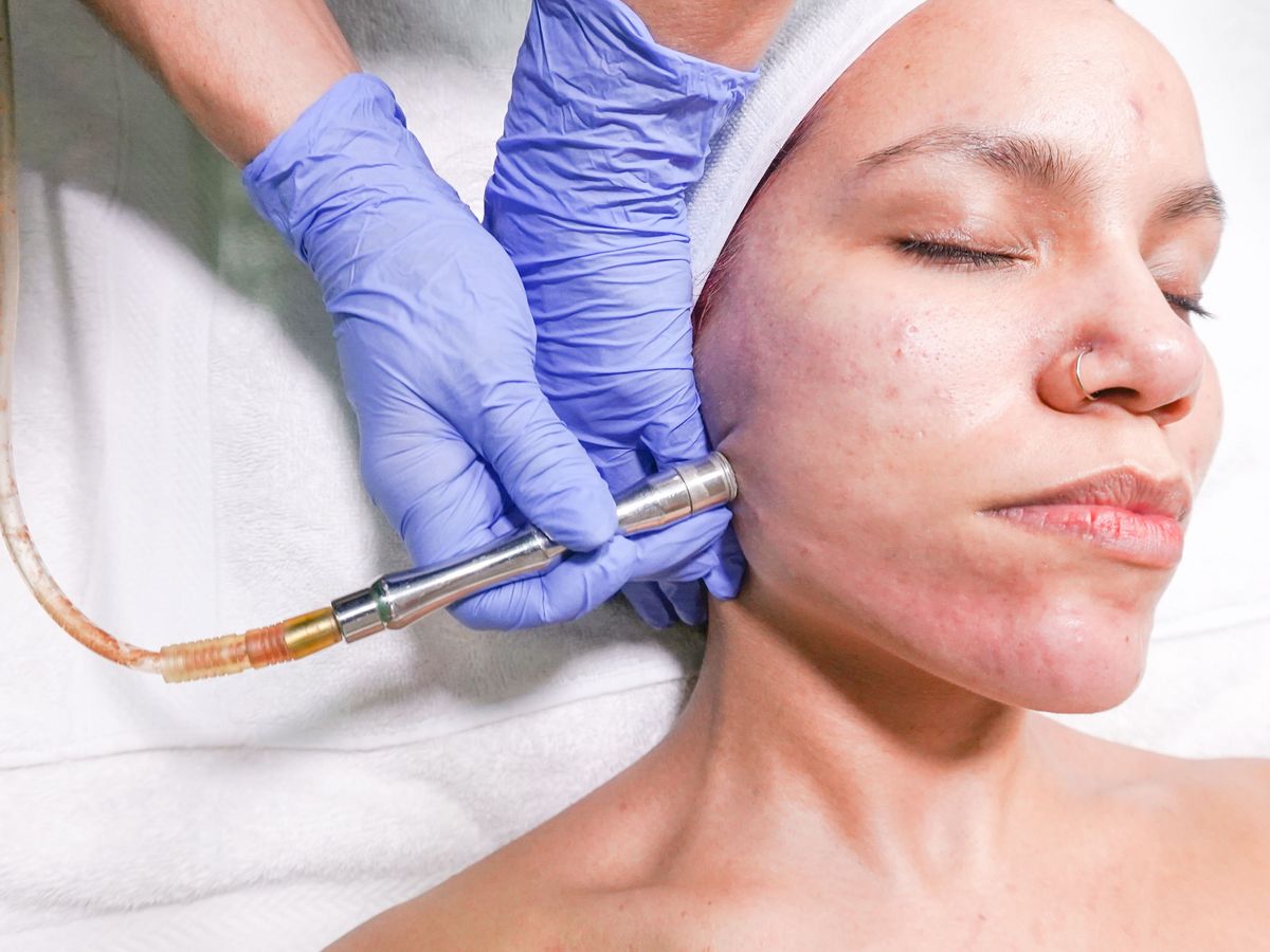 Microdermabrasion treatment