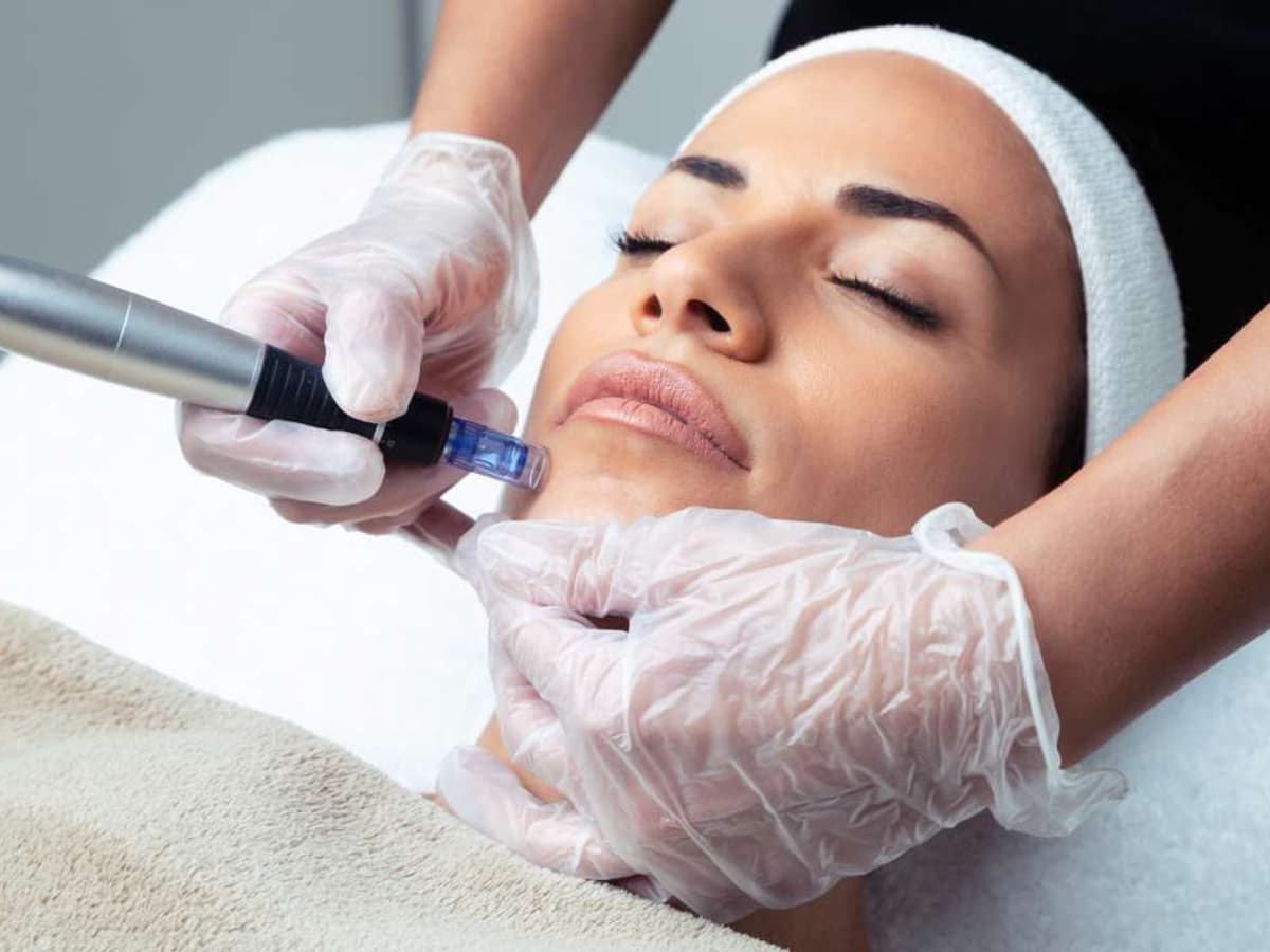 Microneedling