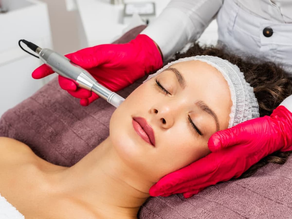 PRP Microneedling (Vampire Facial)