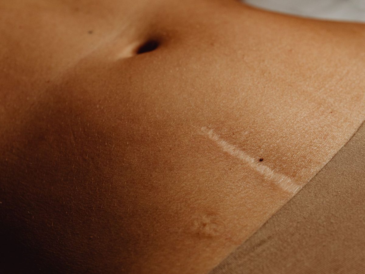 Scar Revision treatment