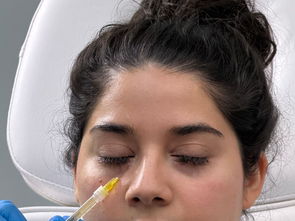 Under-Eye Filler